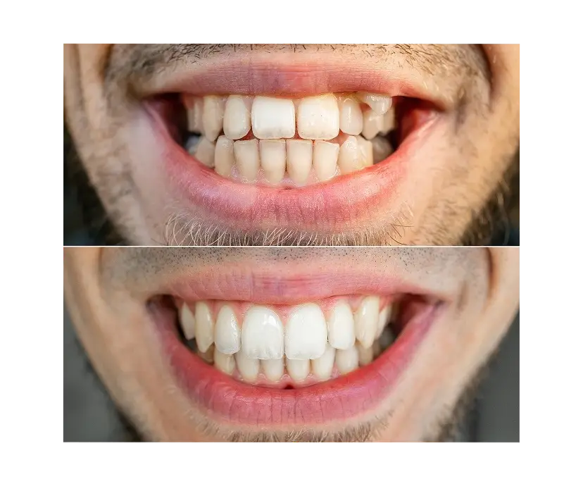 braces helped crooked teeth to aligned 