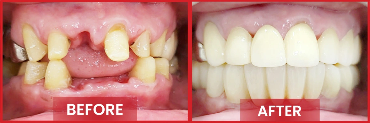 dental implants before and after 