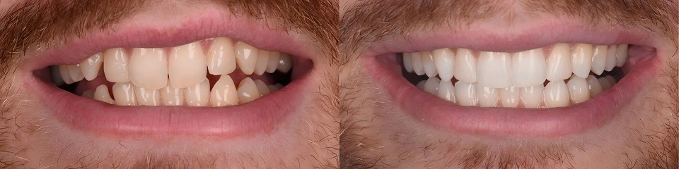 clear aligners before and after results 
