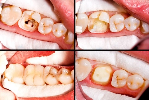 root canal before and after results 