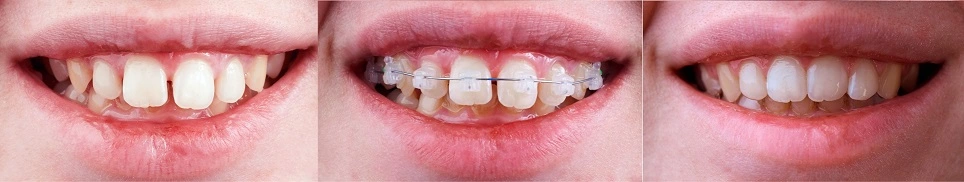  teeth before and after braces 
