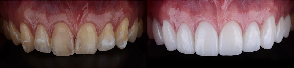 teeth veneers before and after result